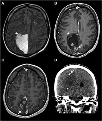 Primary Leptomeningeal Oligodendroglioma, IDH-Mutant, 1p/19q-Codeleted